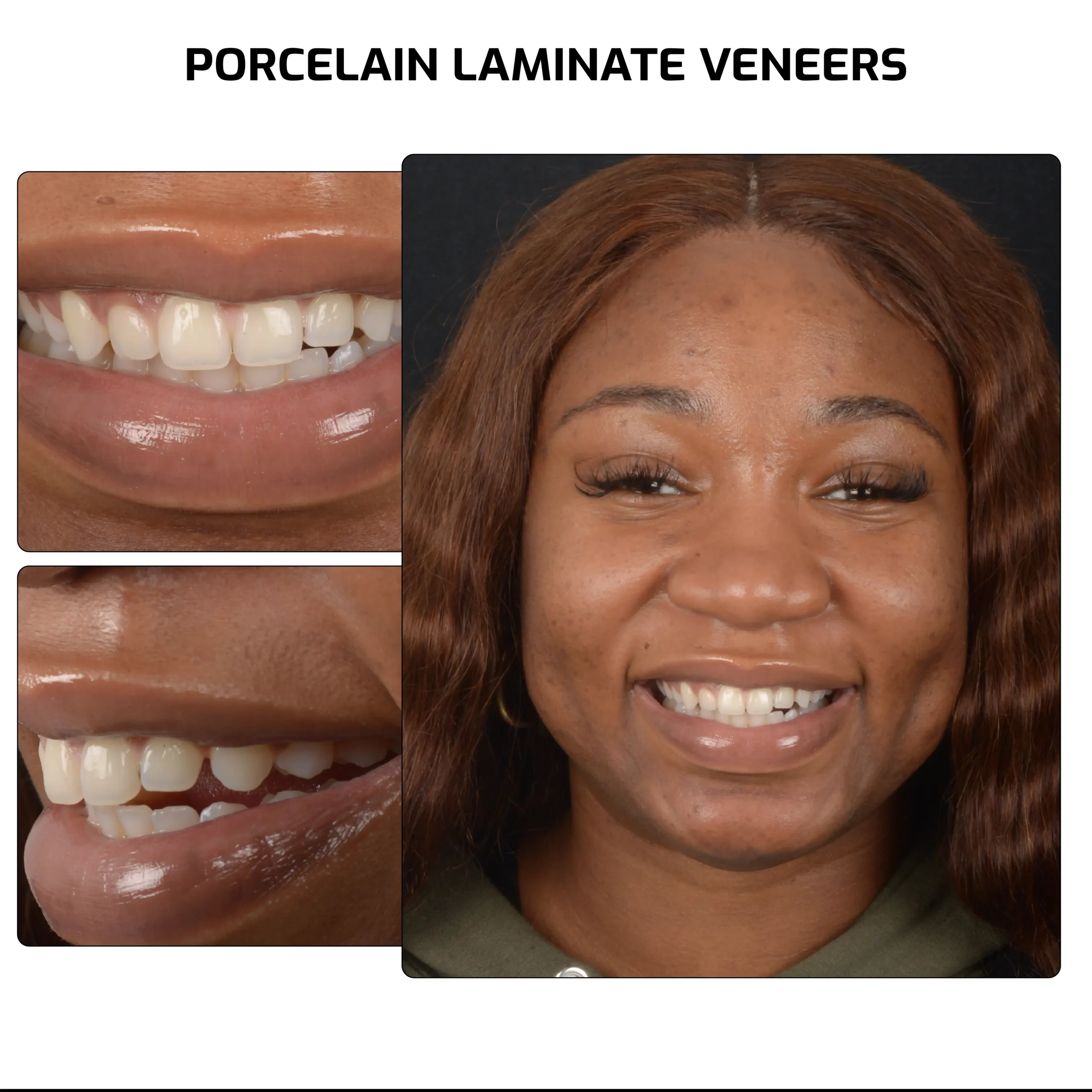 veneers 01 scaled