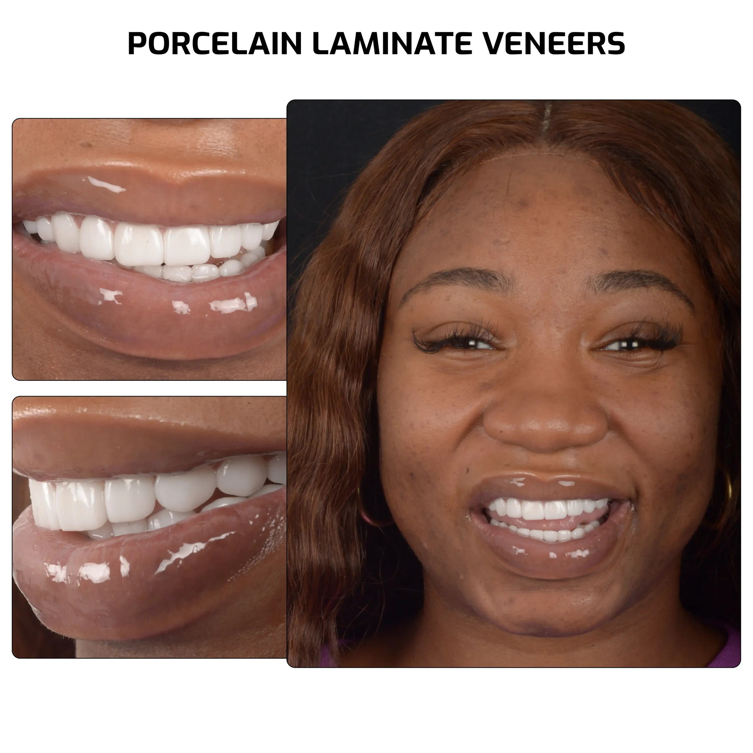 veneers 02 scaled